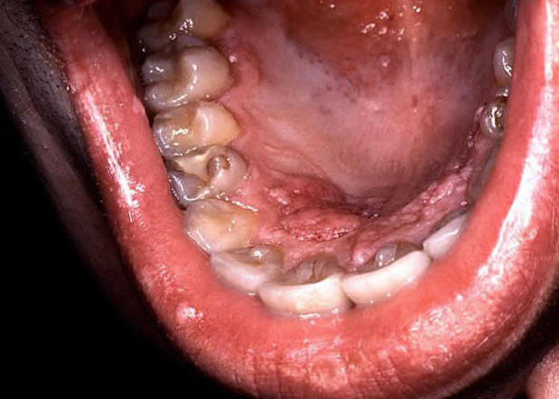 Mouth Cancer From Hpv Virus Reaches All Time High Oral Cancer News