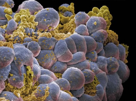 Cracking the Cancer Code A cluster of breast cancer cells, with blue ones marking actively growing cells and yellow marking dying cells. Could scientists crack their code next?